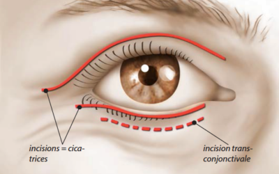 Pour faire disparaître mes cernes, j’ai opté pour la blépharoplastie !