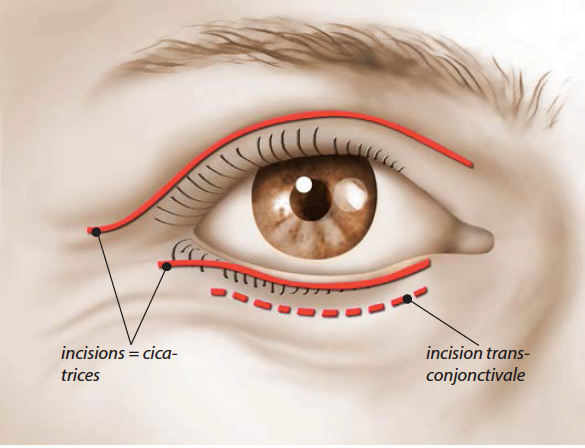 La blépharoplastie expliquée avec un schéma