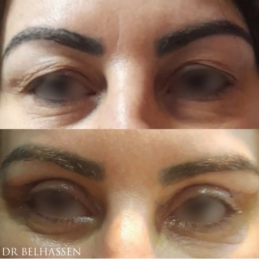 Les effets d'une blépharoplastie